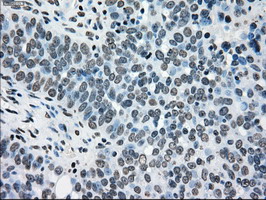 TYRO3 Antibody - IHC of paraffin-embedded Adenocarcinoma of ovary tissue using anti-TYRO3 mouse monoclonal antibody. (Dilution 1:50).