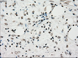 TYRO3 Antibody - IHC of paraffin-embedded Carcinoma of pancreas tissue using anti-TYRO3 mouse monoclonal antibody. (Dilution 1:50).