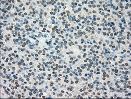 TYRO3 Antibody - IHC of paraffin-embedded Carcinoma of thyroid tissue using anti-TYRO3 mouse monoclonal antibody. (Dilution 1:50).