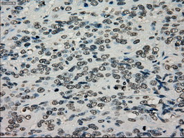 TYRO3 Antibody - IHC of paraffin-embedded Carcinoma of bladder tissue using anti-TYRO3 mouse monoclonal antibody. (Dilution 1:50).