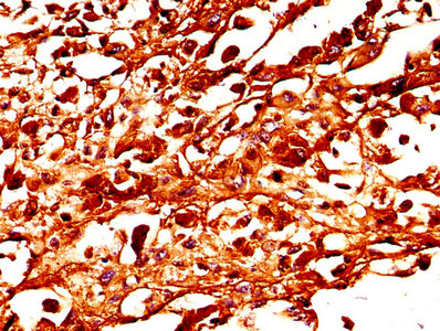 Tyrosinase Antibody - IHC image of TYR Antibody diluted at 1:300 and staining in paraffin-embedded human melanoma performed on a Leica BondTM system. After dewaxing and hydration, antigen retrieval was mediated by high pressure in a citrate buffer (pH 6.0). Section was blocked with 10% normal goat serum 30min at RT. Then primary antibody (1% BSA) was incubated at 4°C overnight. The primary is detected by a biotinylated secondary antibody and visualized using an HRP conjugated SP system.