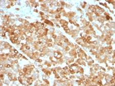 Tyrosinase Antibody - Formalin-fixed, paraffin-embedded melanoma stained with Tyrosinase antibody (OCA1/812).  This image was taken for the unmodified form of this product. Other forms have not been tested.