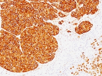 Tyrosinase Antibody - Formalin-fixed, paraffin-embedded human melanoma stained with Tyrosinase antibody (SPM360).  This image was taken for the unmodified form of this product. Other forms have not been tested.