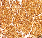 Tyrosinase Antibody - Tyrosinase antibody T311 immunohistochemistry melanoma 10X.  This image was taken for the unmodified form of this product. Other forms have not been tested.