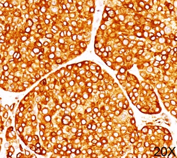 Tyrosinase Antibody - Tyrosinase antibody T311 immunohistochemistry melanoma 20X.  This image was taken for the unmodified form of this product. Other forms have not been tested.