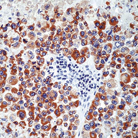 Tyrosinase Antibody - Formalin-fixed, paraffin-embedded human melanoma stained with Tyrosinase antibody.
