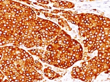 Tyrosinase Antibody - Formalin-fixed, paraffin-embedded melanoma stained with TYR antibody (T311 + OCA1/812).  This image was taken for the unmodified form of this product. Other forms have not been tested.