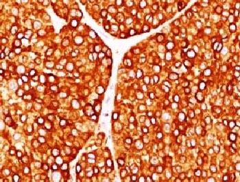 Tyrosinase Antibody - IHC testing of FFPE human melanoma with Tyrosinase antibody (clone TRSN1-1).  This image was taken for the unmodified form of this product. Other forms have not been tested.