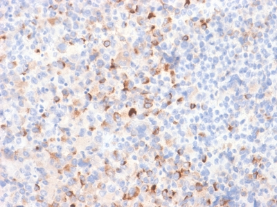 Tyrosinase Antibody - Formalin-fixed, paraffin-embedded Melanoma stained with Tyrosinase Rabbit Recombinant Monoclonal Antibody (TYR/2024R).