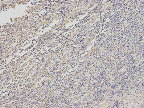 Tyrosinase Antibody - Immunohistochemistry of paraffin-embedded human stomach cancer using TYR antibody at dilution of 1:100 (200x lens).
