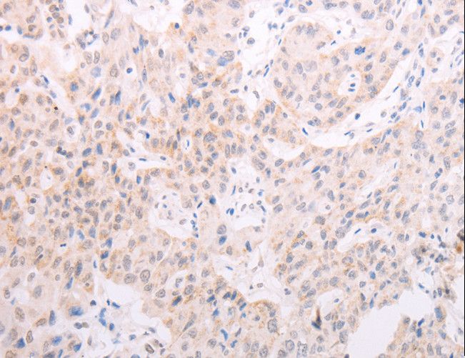 Tyrosinase Antibody - Immunohistochemistry of paraffin-embedded Human lung cancer using TYR Polyclonal Antibody at dilution of 1:30.