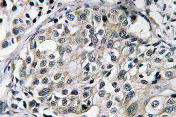 Tyrosine Aminotransferase Antibody - IHC of TAT (E304) pAb in paraffin-embedded human breast carcinoma tissue.