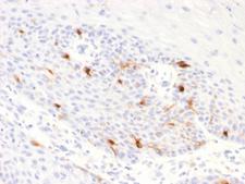 TYRP1 / gp75 Antibody - Formalin-fixed, paraffin-embedded human Basal Cell Carcinoma stained with TYRP1 Recombinant Rabbit Monoclonal Antibody (TYRP1/2340R).