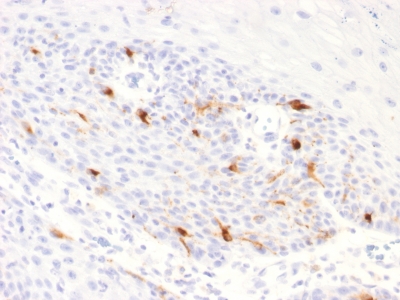 TYRP1 / gp75 Antibody - Formalin-fixed, paraffin-embedded human Basal Cell Carcinoma stained with TYRP1 Recombinant Rabbit Monoclonal Antibody (TYRP1/2340R).