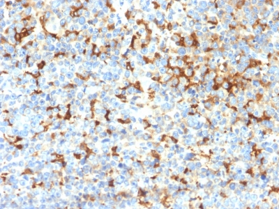 TYRP1 / gp75 Antibody - Formalin-fixed, paraffin-embedded human Melanoma stained with TYRP1 Recombinant Rabbit Monoclonal Antibody (TYRP1/2340R); using DAB Chromogen.