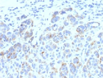 TYRP1 / gp75 Antibody - Formalin-fixed, paraffin-embedded human melanoma stained with TRP1 antibody (SPM611).  This image was taken for the unmodified form of this product. Other forms have not been tested.