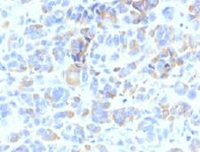 TYRP1 / gp75 Antibody - Formalin-fixed, paraffin-embedded human melanoma stained with TYRP1 antibody (TYRP1/807).  This image was taken for the unmodified form of this product. Other forms have not been tested.