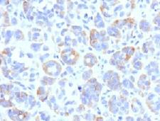 TYRP1 / gp75 Antibody - IHC testing of FFPE human melanoma with TRP1 antibody (clone TYRR1-1).  This image was taken for the unmodified form of this product. Other forms have not been tested.