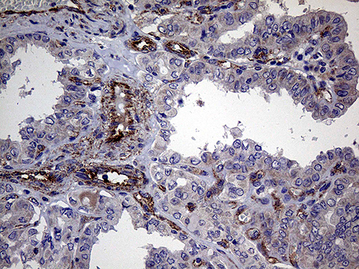 TYW2 / TRMT12 Antibody - Immunohistochemical staining of paraffin-embedded Carcinoma of Human thyroid tissue using anti-TRMT12 mouse monoclonal antibody. (Heat-induced epitope retrieval by 1mM EDTA in 10mM Tris buffer. (pH8.5) at 120°C for 3 min. (1:500)
