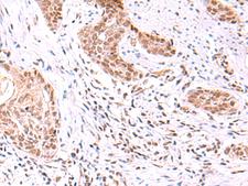 TYW2 / TRMT12 Antibody - Immunohistochemistry of paraffin-embedded Human esophagus cancer tissue  using TRMT12 Polyclonal Antibody at dilution of 1:80(×200)