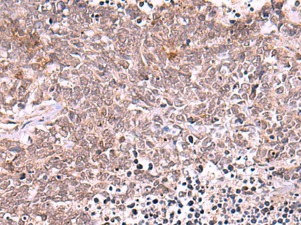 TYW2 / TRMT12 Antibody - Immunohistochemistry of paraffin-embedded Human lung cancer tissue  using TRMT12 Polyclonal Antibody at dilution of 1:80(×200)