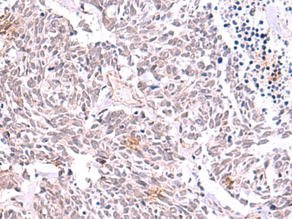 TYW2 / TRMT12 Antibody - Immunohistochemistry of paraffin-embedded Human lung cancer tissue  using TRMT12 Polyclonal Antibody at dilution of 1:85(×200)