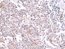 TYW2 / TRMT12 Antibody - Immunohistochemistry of paraffin-embedded Human lung cancer tissue  using TRMT12 Polyclonal Antibody at dilution of 1:85(×200)