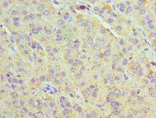 U2AF1 Antibody - Immunohistochemistry of paraffin-embedded human liver cancer using antibody at 1:100 dilution.