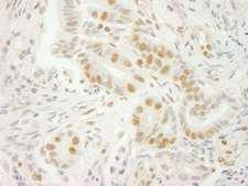 U2AF1 Antibody - Detection of Human U2AF35 by Immunohistochemistry. Sample: FFPE section of human stomach carcinoma. Antibody: Affinity purified rabbit anti-U2AF35 used at a dilution of 1:250.