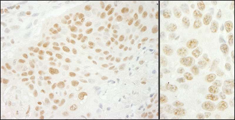 U2AF1 Antibody - Detection of Human and Mouse U2AF35 by Immunohistochemistry. Sample: FFPE section of human lung carcinoma (left) and mouse CT26 colon carcinoma (right). Antibody: Affinity purified rabbit anti-U2AF35 used at a dilution of 1:200 (1 ug/ml). Detection: DAB.