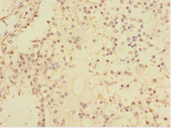 U2AF1L4 Antibody - Immunohistochemistry of paraffin-embedded human breast cancer at dilution 1:100