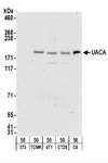 UACA Antibody - Detection of Human UACA by Immunohistochemistry. Sample: FFPE section of human prostate carcinoma. Antibody: Affinity purified rabbit anti-UACA used at a dilution of 1:1000 (1 ug/ml). Detection: DAB.