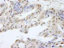 UACA Antibody - Detection of Human UACA by Immunohistochemistry. Sample: FFPE section of human ovarian carcinoma. Antibody: Affinity purified rabbit anti-UACA used at a dilution of 1:250.