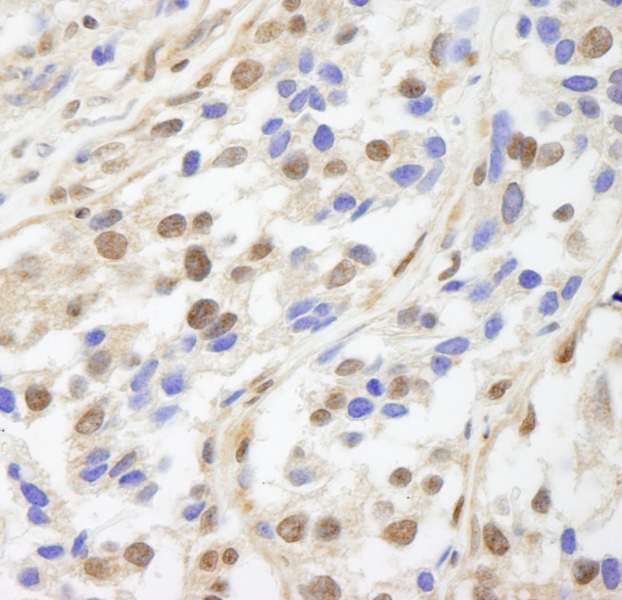UACA Antibody - Detection of Human UACA by Immunohistochemistry. Sample: FFPE section of human breast carcinoma. Antibody: Affinity purified rabbit anti-UACA used at a dilution of 1:250.