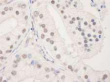 UACA Antibody - Detection of Human UACA by Immunohistochemistry. Sample: FFPE section of human prostate carcinoma. Antibody: Affinity purified rabbit anti-UACA used at a dilution of 1:1000 (1 ug/ml). Detection: DAB.