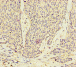 UACA Antibody - Immunohistochemistry of paraffin-embedded human ovarian cancer at dilution of 1:100