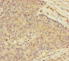 UACA Antibody - Immunohistochemistry of paraffin-embedded human ovarian cancer at dilution of 1:100