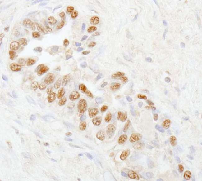 UBA1 / UBE1 Antibody - Detection of Human UBE1 by Immunohistochemistry. Sample: FFPE section of human prostate carcinoma. Antibody: Affinity purified rabbit anti-UBE1 used at a dilution of 1:1000 (1 ug/ml). Detection: DAB.