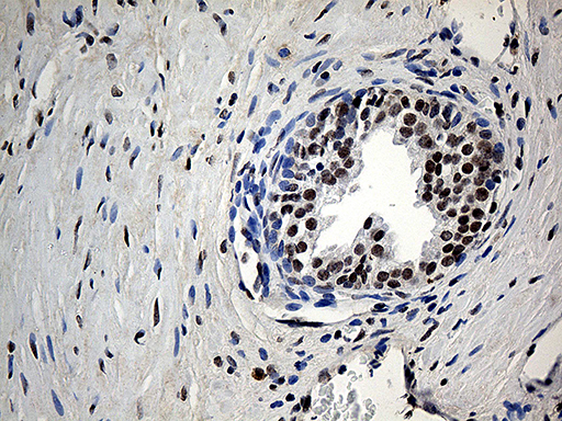 UBA3 / UBE1C Antibody - Immunohistochemical staining of paraffin-embedded Carcinoma of Human prostate tissue using anti-UBA3 mouse monoclonal antibody. (Heat-induced epitope retrieval by 1mM EDTA in 10mM Tris buffer. (pH8.5) at 120°C for 3 min. (1:500)