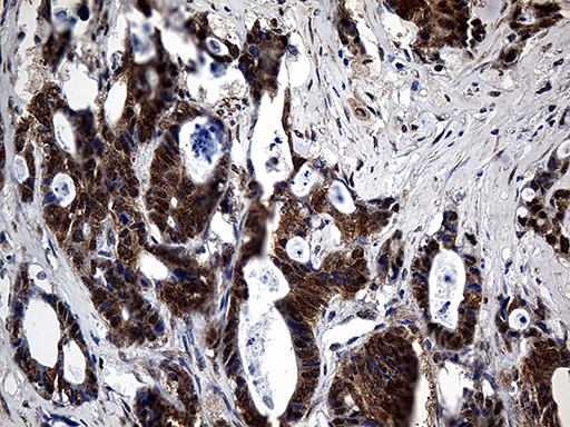 UBA3 / UBE1C Antibody - Immunohistochemical staining of paraffin-embedded Adenocarcinoma of Human colon tissue using anti-UBA3 mouse monoclonal antibody. (Heat-induced epitope retrieval by 1mM EDTA in 10mM Tris buffer. (pH8.5) at 120°C for 3 min. (1:500)
