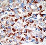 UBA3 / UBE1C Antibody - Formalin-fixed and paraffin-embedded human cancer tissue reacted with the primary antibody, which was peroxidase-conjugated to the secondary antibody, followed by DAB staining. This data demonstrates the use of this antibody for immunohistochemistry; clinical relevance has not been evaluated. BC = breast carcinoma; HC = hepatocarcinoma.