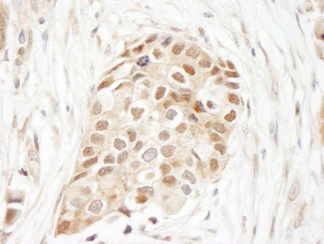 UBA52 Antibody - Detection of Human Ubiquitin by Immunohistochemistry. Sample: FFPE section of human breast carcinoma. Antibody: Affinity purified rabbit anti-Ubiquitin used at a dilution of 1:250.