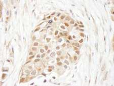UBA52 Antibody - Detection of Human Ubiquitin by Immunohistochemistry. Sample: FFPE section of human breast carcinoma. Antibody: Affinity purified rabbit anti-Ubiquitin used at a dilution of 1:250.