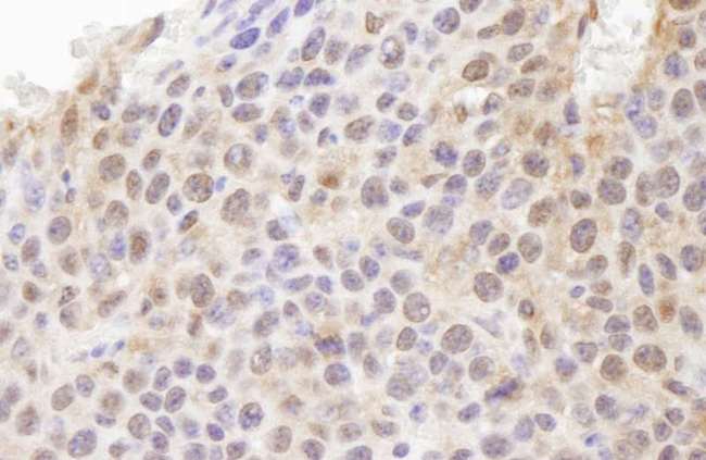 UBA52 Antibody - Detection of Mouse Ubiquitin by Immunohistochemistry. Sample: FFPE section of mouse colon carcinoma. Antibody: Affinity purified rabbit anti-Ubiquitin used at a dilution of 1:250.