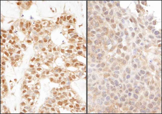 UBA52 Antibody - Detection of Human and Mouse Ubiquitin by Immunohistochemistry. Sample: FFPE sections of human breast carcinoma (left) and mouse teratoma (right). Antibody: Affinity purified rabbit anti-Ubiquitin used at a dilution of 1:1000 (1 ug/ml). Detection: DAB.