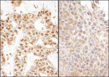 UBA52 Antibody - Detection of Human and Mouse Ubiquitin by Immunohistochemistry. Sample: FFPE sections of human breast carcinoma (left) and mouse teratoma (right). Antibody: Affinity purified rabbit anti-Ubiquitin used at a dilution of 1:1000 (1 ug/ml). Detection: DAB.