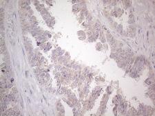 UBA52 Antibody - Immunohistochemical staining of paraffin-embedded Adenocarcinoma of Human ovary tissue using anti-UBA52 mouse monoclonal antibody. (Heat-induced epitope retrieval by 1mM EDTA in 10mM Tris buffer. (pH8.5) at 120°C for 3 min. (1:150)