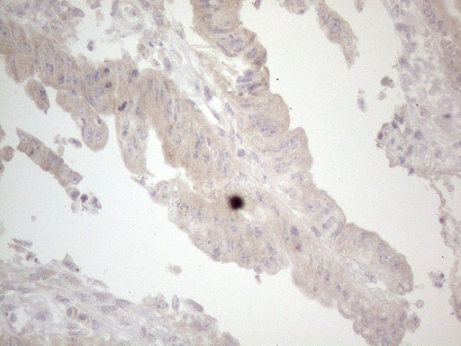 UBA52 Antibody - Immunohistochemical staining of paraffin-embedded Adenocarcinoma of Human colon tissue using anti-UBA52 mouse monoclonal antibody. (Heat-induced epitope retrieval by 1mM EDTA in 10mM Tris buffer. (pH8.5) at 120°C for 3 min. (1:150)