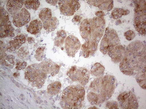 UBA52 Antibody - Immunohistochemical staining of paraffin-embedded Carcinoma of Human liver tissue using anti-UBA52 mouse monoclonal antibody. (Heat-induced epitope retrieval by 1mM EDTA in 10mM Tris buffer. (pH8.5) at 120°C for 3 min. (1:150)