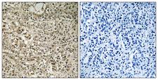 UBA52 Antibody - Peptide - + Immunohistochemistry analysis of paraffin-embedded human breast carcinoma tissue using RPL40 antibody.